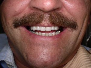 veneers example 2 - after A